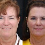 Blepharoplasty Before and After Photos in Cincinnati, OH, Patient 5485