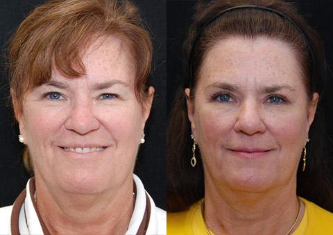 Blepharoplasty Before and After Photos in Cincinnati, OH, Patient 5485