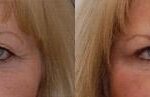 Blepharoplasty Before and After Photos in Cincinnati, OH, Patient 5488