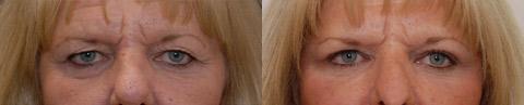 Blepharoplasty Before and After Photos in Cincinnati, OH, Patient 5488