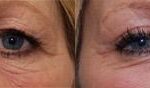 Blepharoplasty Before and After Photos in Cincinnati, OH, Patient 5491