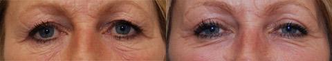 Blepharoplasty Before and After Photos in Cincinnati, OH, Patient 5491