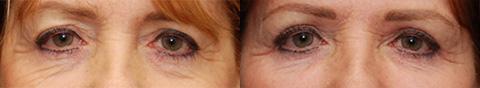 Blepharoplasty Before and After Photos in Cincinnati, OH, Patient 5494