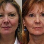 Blepharoplasty Before and After Photos in Cincinnati, OH, Patient 5497