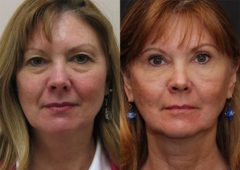 Blepharoplasty Before and After Photos in Cincinnati, OH, Patient 5497