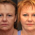 Blepharoplasty Before and After Photos in Cincinnati, OH, Patient 5505
