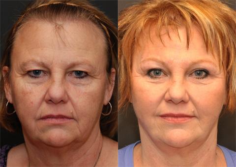 Blepharoplasty Before and After Photos in Cincinnati, OH, Patient 5505