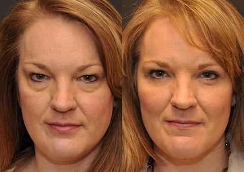 Blepharoplasty Before and After Photos in Cincinnati, OH, Patient 5508