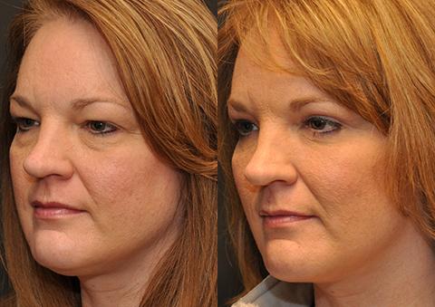 Blepharoplasty Before and After Photos in Cincinnati, OH, Patient 5508