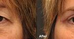 Blepharoplasty Before and After Photos in Cincinnati, OH, Patient 5516