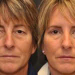 Blepharoplasty Before and After Photos in Cincinnati, OH, Patient 5516