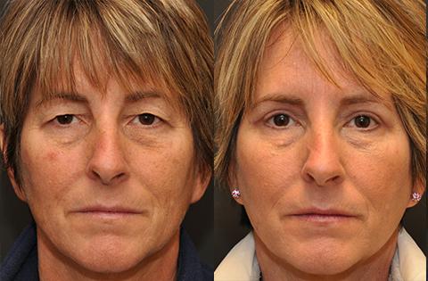 Blepharoplasty Before and After Photos in Cincinnati, OH, Patient 5516