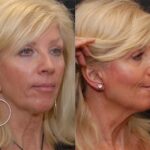 Earlobe Reduction Surgery Before and After Photos in Cincinnati, OH, Patient 5633