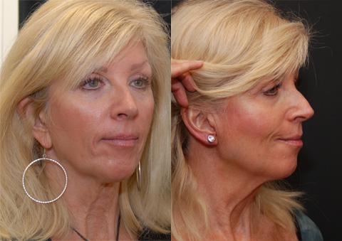 Earlobe Reduction Surgery Before and After Photos in Cincinnati, OH