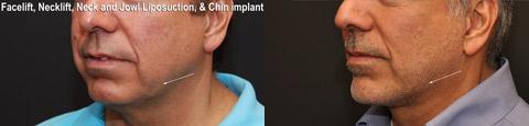 Facial Liposuction Before and After Photos in Cincinnati, OH, Patient 5636