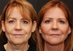 Facial Liposuction Before and After Photos in Cincinnati, OH, Patient 5643