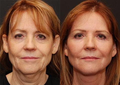 Facial Liposuction Before and After Photos in Cincinnati, OH