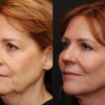 Facial Liposuction Before and After Photos in Cincinnati, OH, Patient 5643