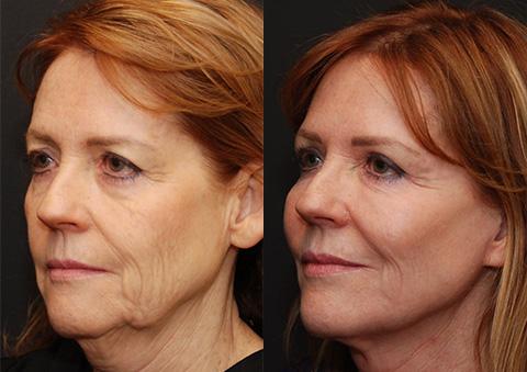 Facial Liposuction Before and After Photos in Cincinnati, OH, Patient 5643