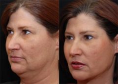 Facial Liposuction Before and After Photos in Cincinnati, OH, Patient 5650