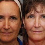 Facial Liposuction Before and After Photos in Cincinnati, OH, Patient 5653