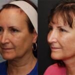 Facial Liposuction Before and After Photos in Cincinnati, OH, Patient 5653