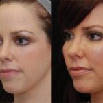 Fat Transfer Before and After Photos in Cincinnati, OH, Patient 5661