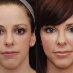 Fat Transfer Before and After Photos in Cincinnati, OH, Patient 5661