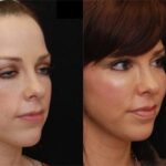 Fat Transfer Before and After Photos in Cincinnati, OH, Patient 5661