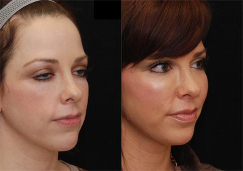 Fat Transfer Before and After Photos in Cincinnati, OH, Patient 5661