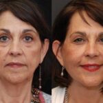 Fat Transfer Before and After Photos in Cincinnati, OH, Patient 5668