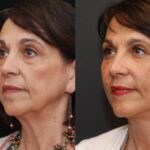 Fat Transfer Before and After Photos in Cincinnati, OH, Patient 5668
