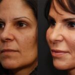 Fat Transfer Before and After Photos in Cincinnati, OH, Patient 5680