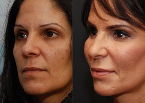 Fat Transfer Before and After Photos in Cincinnati, OH, Patient 5680