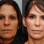 Fat Transfer Before and After Photos in Cincinnati, OH, Patient 5680