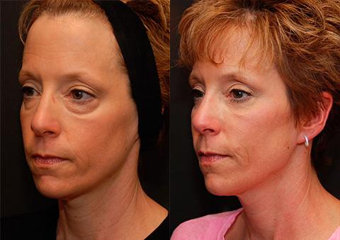 Fat Transfer Before and After Photos in Cincinnati, OH, Patient 5685
