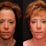 Fat Transfer Before and After Photos in Cincinnati, OH, Patient 5685