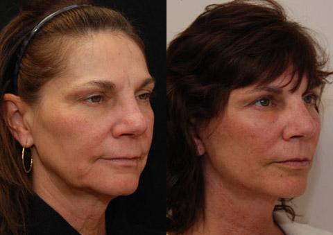 Fat Transfer Before and After Photos in Cincinnati, OH, Patient 5695