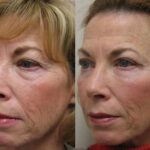Fat Transfer Before and After Photos in Cincinnati, OH, Patient 5702