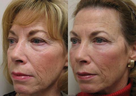 Fat Transfer Before and After Photos in Cincinnati, OH, Patient 5702
