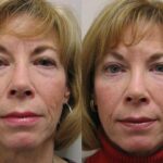 Fat Transfer Before and After Photos in Cincinnati, OH, Patient 5702