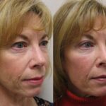 Fat Transfer Before and After Photos in Cincinnati, OH, Patient 5702