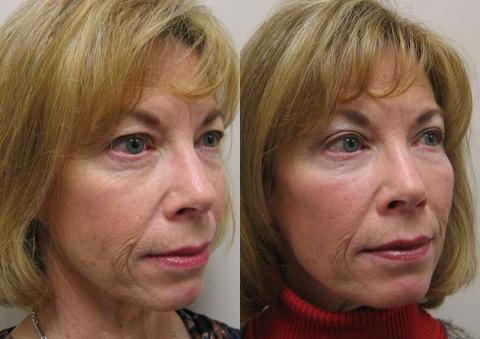 Fat Transfer Before and After Photos in Cincinnati, OH, Patient 5702