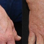 Fat Transfer Before and After Photos in Cincinnati, OH, Patient 5709