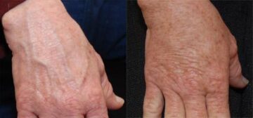 Fat Transfer Before and After Photos in Cincinnati, OH, Patient 5709