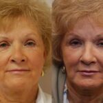 Fat Transfer Before and After Photos in Cincinnati, OH, Patient 5712