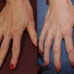 Fat Transfer Before and After Photos in Cincinnati, OH, Patient 5715
