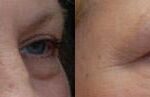 Fat Transfer Before and After Photos in Cincinnati, OH, Patient 5718