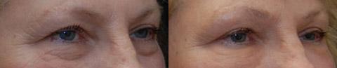 Fat Transfer Before and After Photos in Cincinnati, OH, Patient 5718