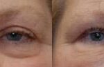 Fat Transfer Before and After Photos in Cincinnati, OH, Patient 5718